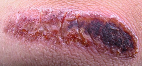 scab_wound_1_by_falln_stock
